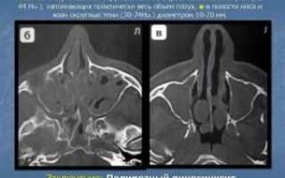 Кистозное утолщение слизистой оболочки верхнечелюстной пазухи