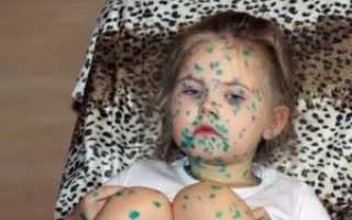 Сопли при ветрянке у ребенка