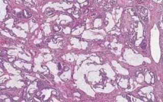 Муцинозная аденокарцинома легкого