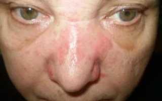 Отек переносицы причины