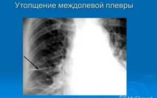 Уплотнение междолевой плевры справа что это