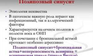 Полипозный полисинусит