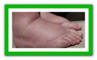 Психосоматика отеки