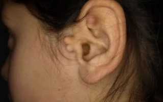 Наросты в ушах у человека