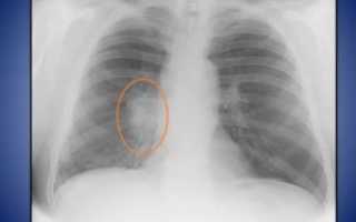 Уплотнение корней легких причины и лечение