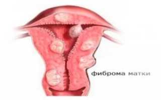 Фиброз матки что такое