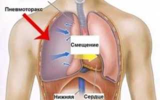 Покалывание в легких