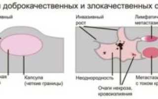 Может ли доброкачественная опухоль перейти в злокачественную