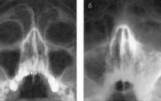 Правосторонний катаральный гайморит