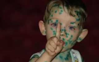 Чем мазать ветрянку во рту у ребенка