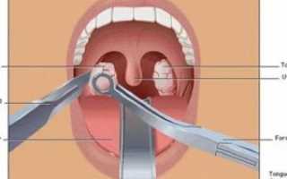 Нужно ли удалять миндалины ребенку
