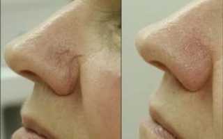 Коагуляция сосудов носа