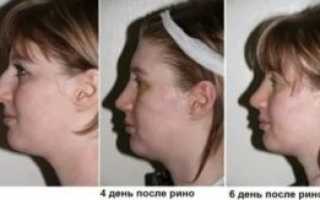 Отек после ринопластики кончика носа