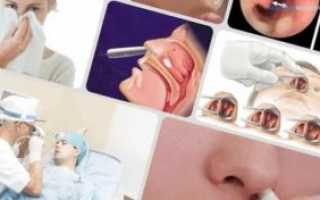 Латеропозиция нижних носовых раковин