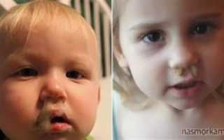 Ребенок гнусавит соплей нет