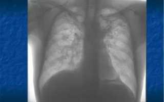 Фиброзно очаговые изменения в легких