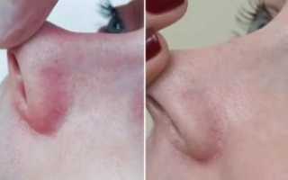 Лопнул сосуд в носу что делать