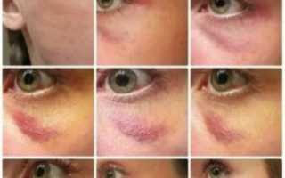Как убрать синяк на носу быстро