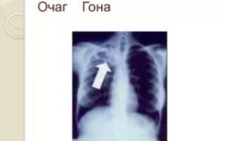 Очаг гона в легких что это