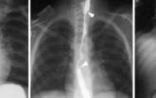 Инородное тело в легких у ребенка симптомы
