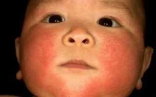 Температура при аллергии у детей комаровский