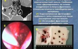 Грибок в гайморовой пазухе