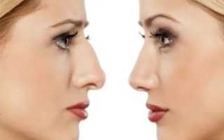 Как убирают горбинку на носу видео