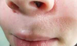 Сыпь на переносице у ребенка