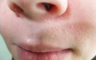 Сыпь на переносице у ребенка