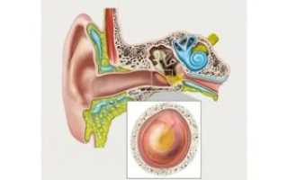 Острый средний серозный отит у взрослых лечение
