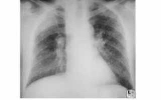 Плевро диафрагмальная спайка справа