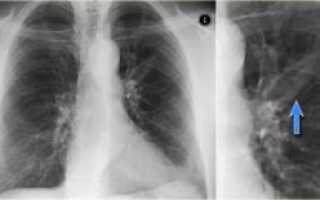 Множественные очаги в легких