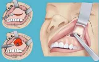 Киста в носу у ребенка