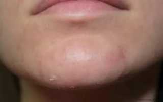 Уплотнение на подбородке под кожей