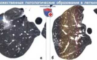 Секундарные изменения в легких