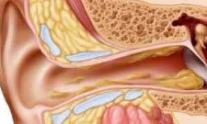 Почему в ушах образуется много серы