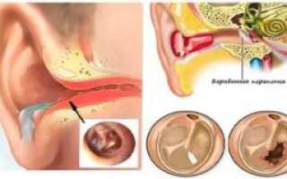 Жидкость в ухе за барабанной перепонкой лечение