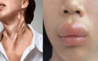 Отек квинке через сколько проходит