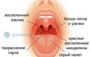 Красные прожилки на миндалинах у ребенка