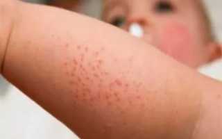 Крапивница при орви у ребенка