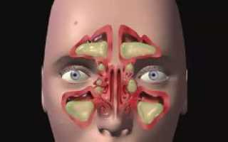 Левосторонний гайморит симптомы лечение