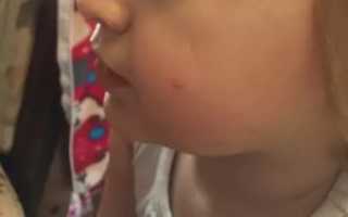 У ребенка прыщ на лице не проходит