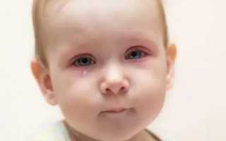 У ребенка красные глаза и насморк