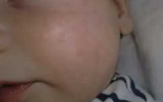 Аллергия на физраствор у ребенка