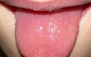 Пузырьки на языке у ребенка фото