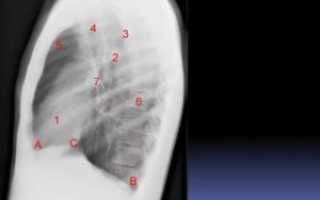 Синусы легких на рентгенограмме