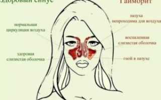 Гайморит без температуры нужны ли антибиотики