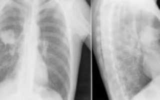 Может ли рентген показать опухоль