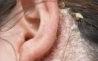 Коросты в ушах у человека