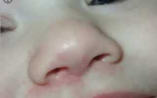 Сыпь под носом у ребенка